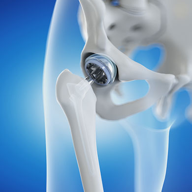 anterior-hip-replacement Orthopedics Doctor Help