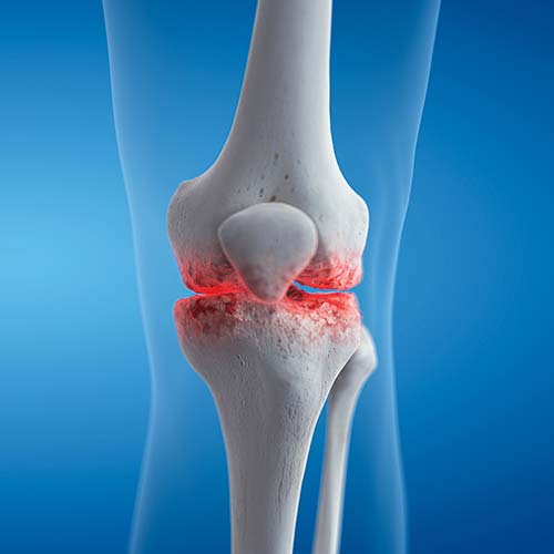 knee-arthritis Orthopedics Doctor Help