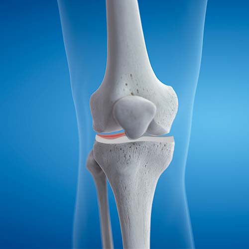 meniscus-tear Orthopedics Doctor Help